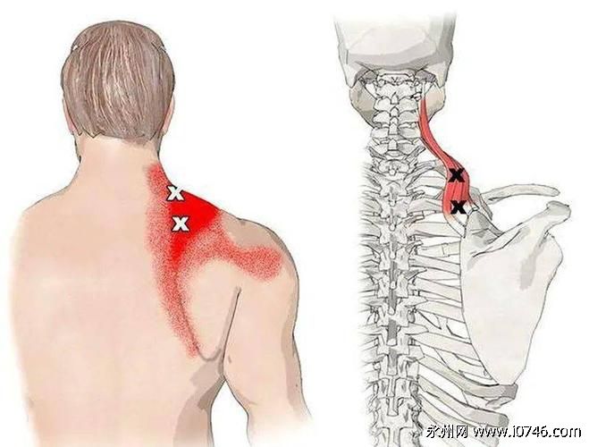 肩胛骨疼痛要警惕的三种病：颈椎病/筋膜炎/肩周炎