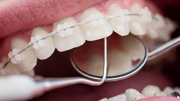 如何应对牙齿矫正期间的不对齐问题？